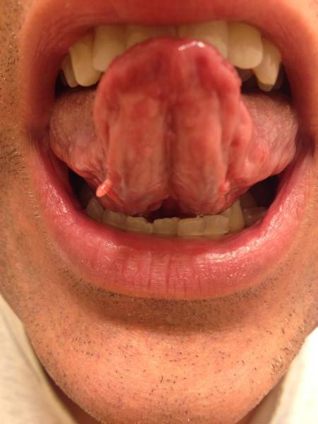 skin tag on tongue